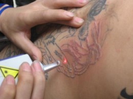 tattoo removal